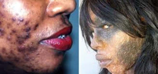 Beauté: Le décapage de la peau fait rage au Cameroun