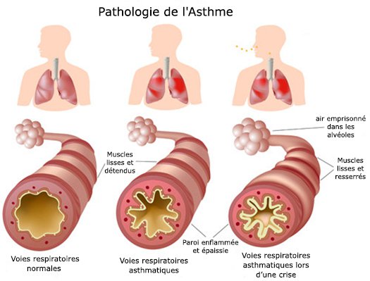 Des remèdes maison pour l’asthme