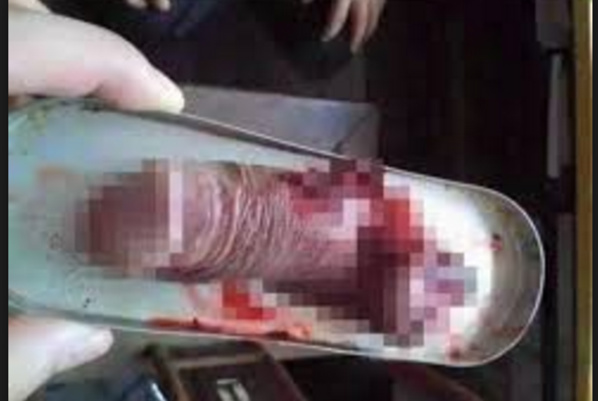 Une fille coupe le pénis de son violeur avec ses dents Une fille coupe le pénis de son violeur avec ses dents