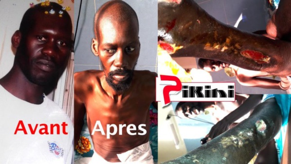 Un militaire est rongé par des plaies depuis 2 ans 5 mois Un militaire est rongé par des plaies depuis 2 ans 5 mois