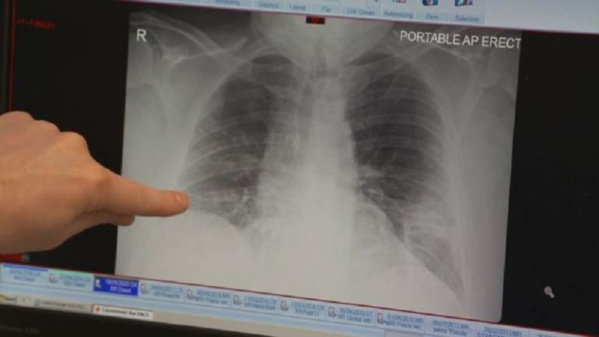Pourquoi votre santé ne sera peut-être plus jamais la même après le Covid-19 Pourquoi votre santé ne sera peut-être plus jamais la même après le Covid-19