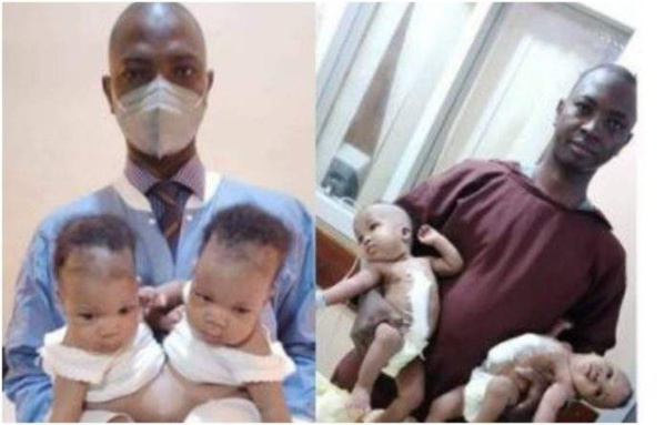 Nigeria : des jumelles siamoises séparées avec succès