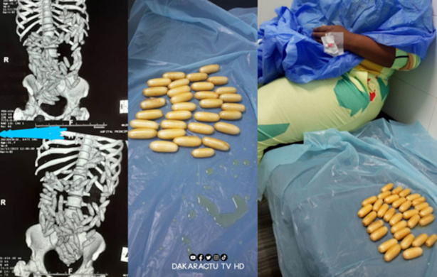 AIBD : Une Sud-Africaine a expulsé 92 boulettes testées positives à la cocaïne AIBD : Une Sud-Africaine a expulsé 92 boulettes testées positives à la cocaïne