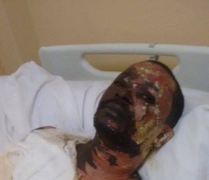 Tentative d'assassinat: Ndèye Diallo verse de l'huile chaude sur son mari et s'enfuie