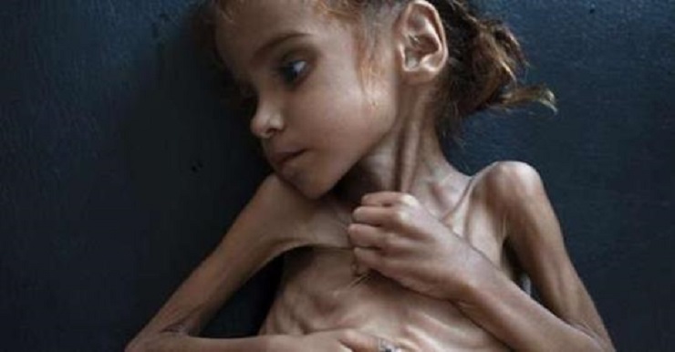 Amal Hussain, la fillette yéménite qui a fait la une  du « New York Times », est morte