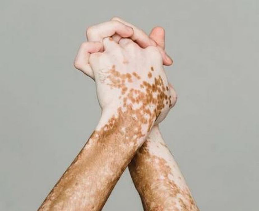 MALADIES DERMATOLOGIQUES : Les effroyables révélations du Dr Khadim Diop