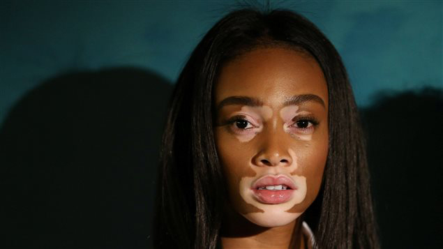 Vitiligo, la maladie qui décolore la peau