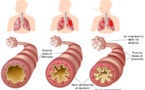 Des remèdes maison pour l’asthme