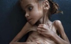 Amal Hussain, la fillette yéménite qui a fait la une  du « New York Times », est morte