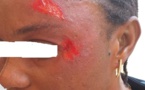 Lycée Blaise Diagne de Dakar: une élève agresse son professeur d’EPS et la défigure... les cours suspendus