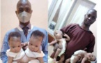 Nigeria : des jumelles siamoises séparées avec succès
