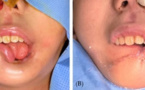 "Noma ou cancrus oris" : Une gangrène de la bouche mortelle dans 90 % des cas