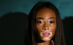 Vitiligo, la maladie qui décolore la peau