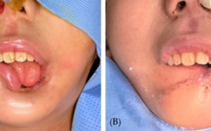 "Noma ou cancrus oris" : Une gangrène de la bouche mortelle dans 90 % des cas